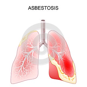 Asbestosis. Close-up of a cross section of human lungs with fibrosis and scarring photo