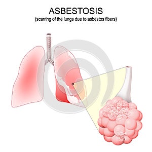 Asbestosis lungs. Close-up of alveolus with asbestos fibers photo