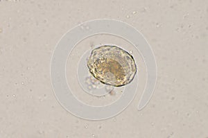 Ascaris lumbricoides egg in stool exam