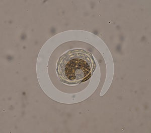 Ascaris lumbricoides egg in stool exam