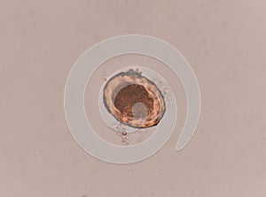 Ascaris lumbricoides egg in stool exam.