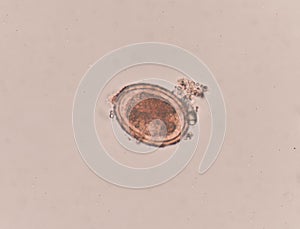 Ascaris lumbricoides egg in stool exam.