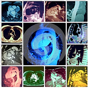 Ascending aorta aneurism pathology colorful collage