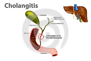 Ascending cholangitis, also known as acute cholangitis or simply cholangitis, is inflammation of the bile duct