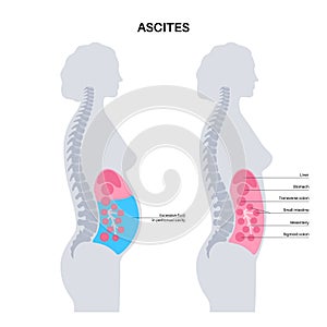 Ascites disease poster