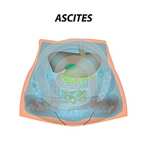 Ascites Free fluid in the abdominal cavity. Infographics. Vector illustration on isolated background.