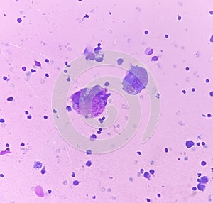 Ascitic fluid cytology. Leishman stain smear show Lymphocytes, polymorphs cells. Abnormal cells. Ascites