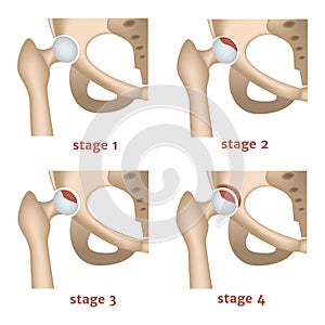 aseptic necrosis. Stages of destruction of the femoral head.