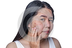 Asian adult woman face has freckles, large pores, blackhead pimple and scars problem from not take care for a long time. Skin