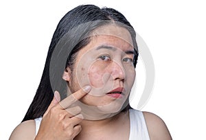 Asian adult woman face has freckles, large pores, blackhead pimple and scars problem from not take care for a long time. Skin