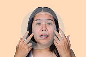 Asian adult woman face has freckles, large pores, blackhead pimple and scars problem from not take care for a long time. Skin