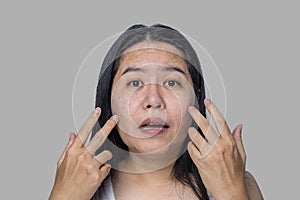 Asian adult woman face has freckles, large pores, blackhead pimple and scars problem from not take care for a long time. Skin