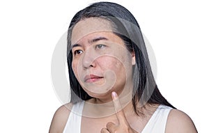 Asian adult woman face has freckles, large pores, blackhead pimple and scars problem from not take care for a long time. Skin