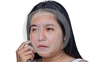 Asian adult woman face has freckles, large pores, blackhead pimple and scars problem from not take care for a long time. Skin