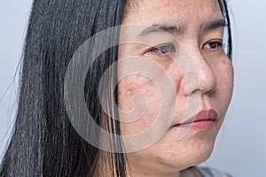 Asian adult woman face has freckles, large pores, blackhead pimple and scars problem from not take care for a long time. Skin