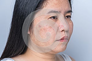 Asian adult woman face has freckles, large pores, blackhead pimple and scars problem from not take care for a long time. Skin