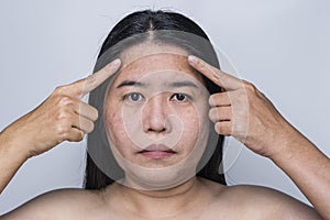 Asian adult woman face has freckles, large pores, blackhead pimple and scars problem from not take care for a long time. Skin