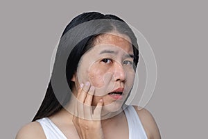 Asian adult woman`s face has freckles, large pores, blackhead pimples and scars problem from not take care for a long time. Skin