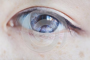 Asian Eye With Contact Lens