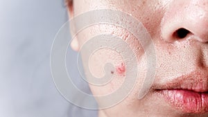Asian face, Macro skin with enlarged pores. Allergic reaction, peeling, care for skin.