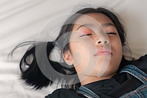 Asian girl has swollen eyes shell, her lay on the bed