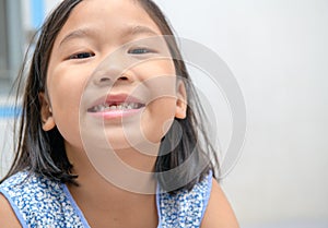 Asian kid girl smile and showing her broken milk teeth. Oral heath concept