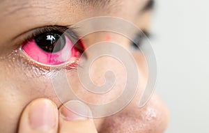 Asian lady woman with conjunctivitis is checking for her pink eye,girl with subconjunctival hemorrhage,bloodshot of the eyes,