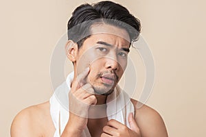 Asian man worry have blemish on face caused by acne