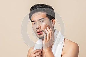Asian man worry have blemish on face caused by acne