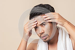 Asian man worry have blemish on face caused by acne photo