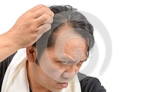 Asian man worry about his  hair loss or alopecia isolated