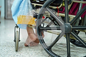 Asian middle-aged lady woman patient sitting on wheelchair with urine bag in the hospital ward