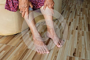 Asian old woman holding a leg that pain from varicose veins on the legs