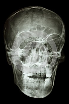 Asian people's skull (Thai people)