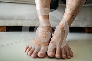 Asian senior woman is show her swollen feet or legs in the area of astragalus,elderly patient with astragalus swelling,ankle bone photo