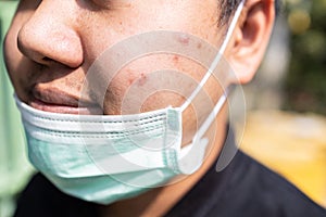 Asian teenager boy with acne on the face caused by wearing medical face mask,accumulation of bacteria from sweat,skin irritation,