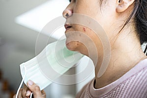 Asian woman with acne on the face caused by wearing medical mask,accumulation of fungi,bacteria from sweat,skin irritation,