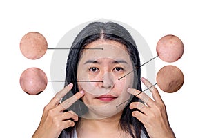 Asian woman face has freckles, large pores, blackhead pimple and scars problem from not take care for long time. Skin problem face