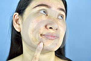 Asian woman finger point at whitehead acne on the chin, Adult worry about facial skin problem. photo