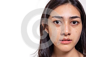 Asian woman gets freckles, blemish, pimple and dull skin on her face. Attractive beautiful Asia woman get eye dark circles, She ge photo