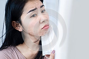 Asian woman having a problem with acne and rash skin allergy under chin and face after wearing a protective mask