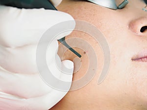 Asian woman patient on laser procedure skin resurfacing in aesthetic medicine.