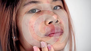 Asian woman is scratching her face from Skin Allergy infected illness. with red rash on her face.