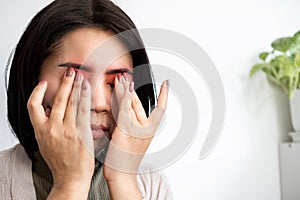Asian woman suffering from eye pain , burning and discomfort , eyestrain concept photo