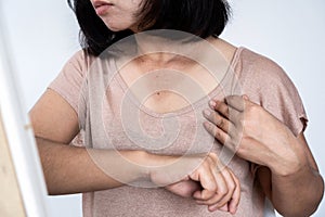 Asian woman with sunburned on neck and arm, skin damage and darker with wrinkles