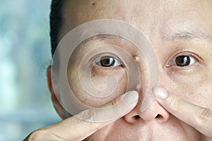 Asian woman try to squeeze nose acne pimples