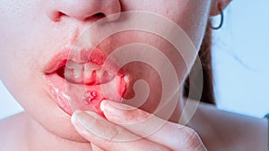 Asian women have aphthous ulcers on mouth on white background, selective focus photo