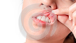 Asian women have aphthous ulcers on mouth on white background, selective focus photo