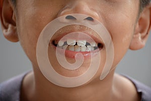 Asian young boy smiling and showing teeth beginning caries or decayed and gapped teeth or diastema in gray blurred background