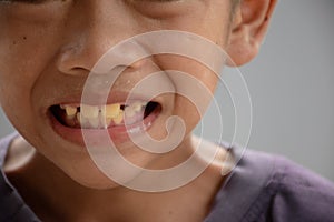 Asian young boy smiling and showing yellow teeth or dental fluorosis and gapped teeth or diastema concept of medical and dentistry